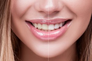 'regular and whitened teeth'