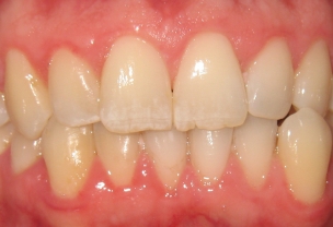 Before Invisalign Treatment