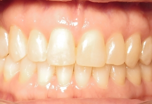 After Invisalign Treatment