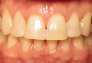 After Invisalign Treatment