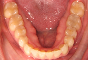 After Invisalign Treatment