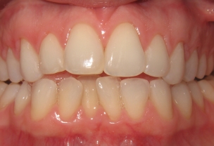 Before Invisalign Treatment