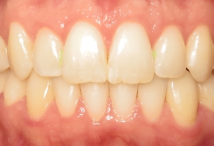 After Invisalign Treatment