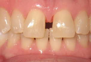 Before Invisalign Treatment