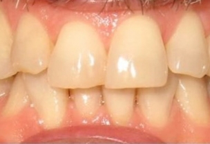 Before Invisalign Treatment