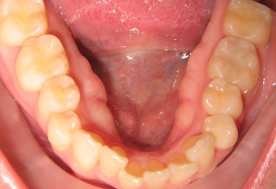 Before Invisalign Treatment