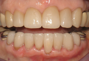 After Veneers Procedure broken discolored front teeth