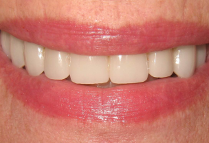 Before Veneers Procedure broken discolored front teeth