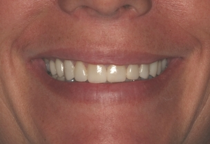 After Veneers Procedure with broken front teeth