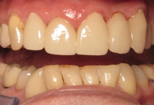 After Veneers Procedure with worn mispositioned teeth