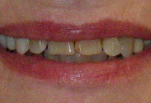 Before Veneers Procedure broken discolored front teeth
