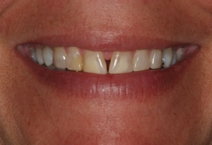 Before Veneers Procedure with broken front teeth