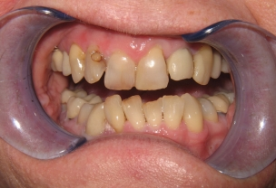 Before Veneers Procedure with worn mispositioned teeth