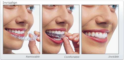Woman wearing Invisalign