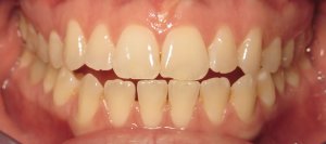 before deep bite correction