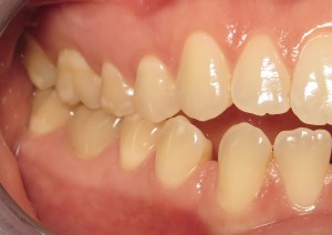 before deep bite correction on the left