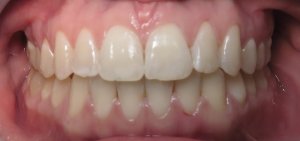 after deep bite correction