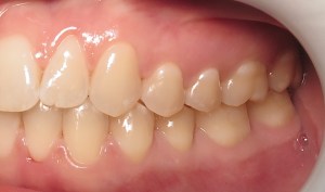 after deep bite correction on the left