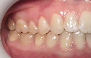 after deep bite correction on the right