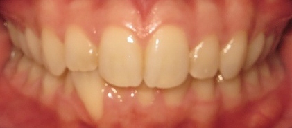 Before Invisalign Treatment
