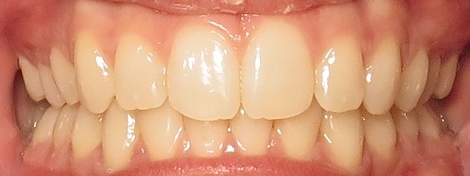 After Invisalign Treatment