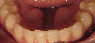 After Invisalign Treatment
