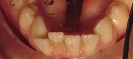 Before Invisalign Treatment