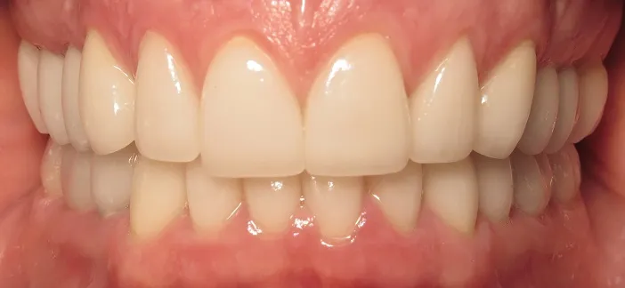 After Veneers Procedurewith worn mispositioned teeth