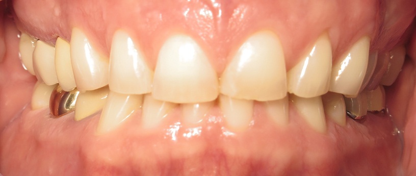 Before Veneers Procedure with worn mispositioned teeth