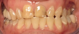 before anterior crowns 