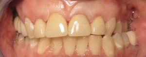 after anterior crowns